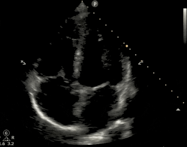 Cardiac Ultrasound Echocardiography Apical 5 Chamber view A5C Ultrasound Video