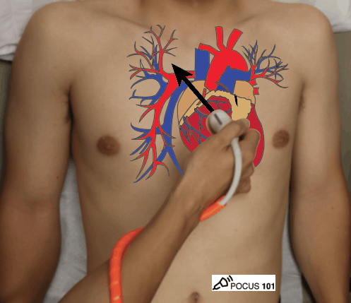Cardiac Ultrasound Echocardiography Parasternal Long Axis View PSLA Hand Position