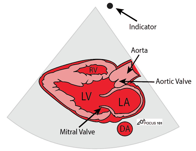 Cardiac Ultrasound Echocardiography Parasternal Long Axis View PSLA PLAX Illustration