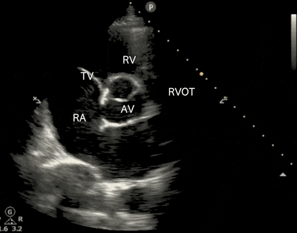 Cardiac Ultrasound Echocardiography Parasternal Short Axis View PSSA PSAX Aortic Valve Level Mercedes Benz Sign Ultrasound Video