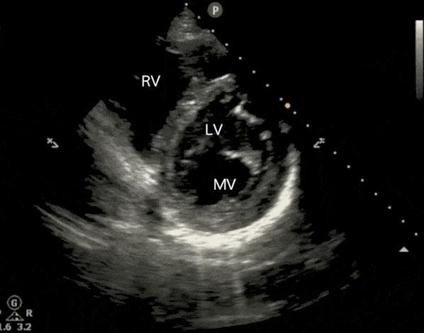Cardiac Ultrasound Echocardiography Parasternal Short Axis View PSSA PSAX Mitral Valve Fish Mouth Ultrasound Video