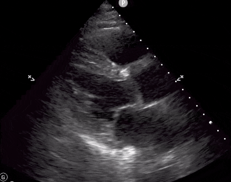 Hyperdynamic LV Left Ventricle Ejection Fraction Function Cardiac Ultrasound Echocardiography