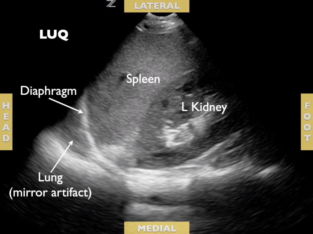 Left Upper Quadrant LUQ eFAST FAST scan Ultrasound - Labeled