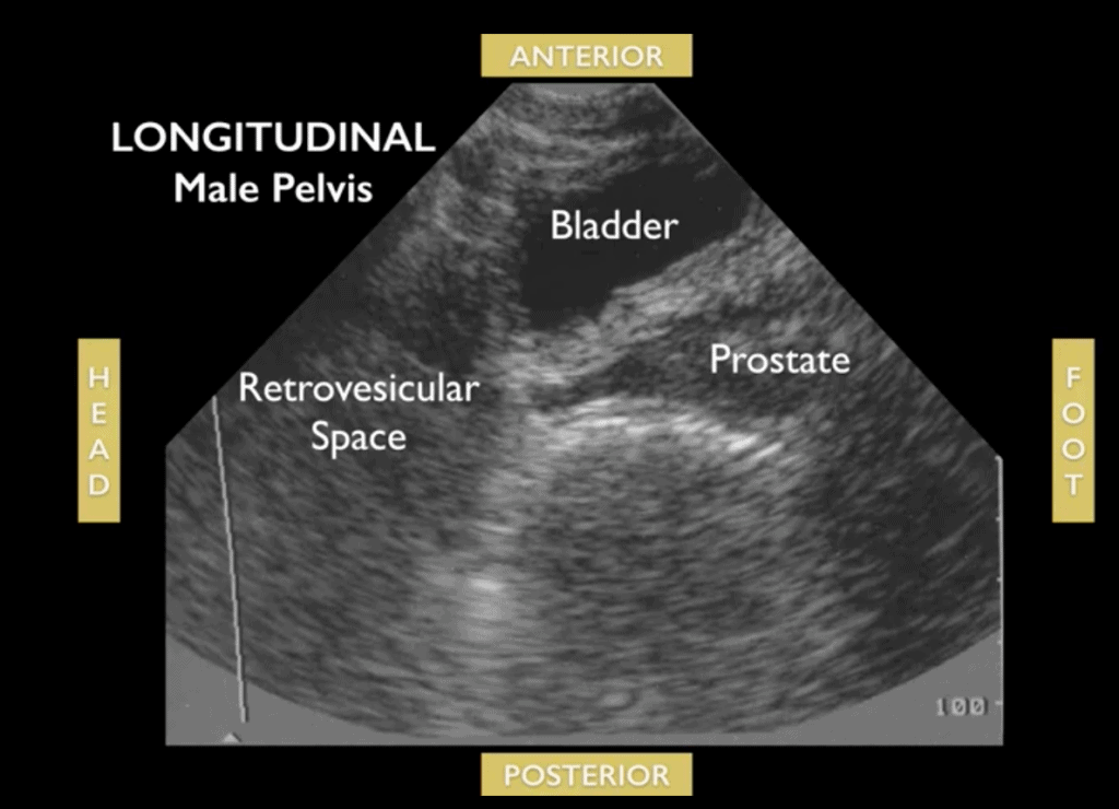Longitudinal Male Pelvis eFAST FAST exam Ultrasound - Labeled