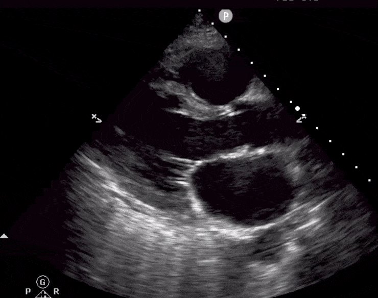 Moderate Decreased LV Left Ventricle Ejection Fraction Function Cardiac Ultrasound Echocardiography POCUS