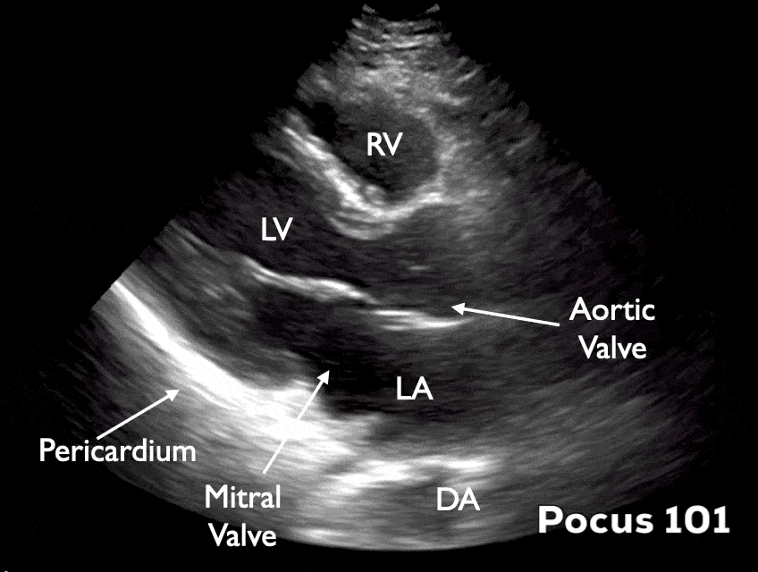 Parasternal Long Axis View Ultrasound Echocardiography Video eFAST FAST scan POCUS