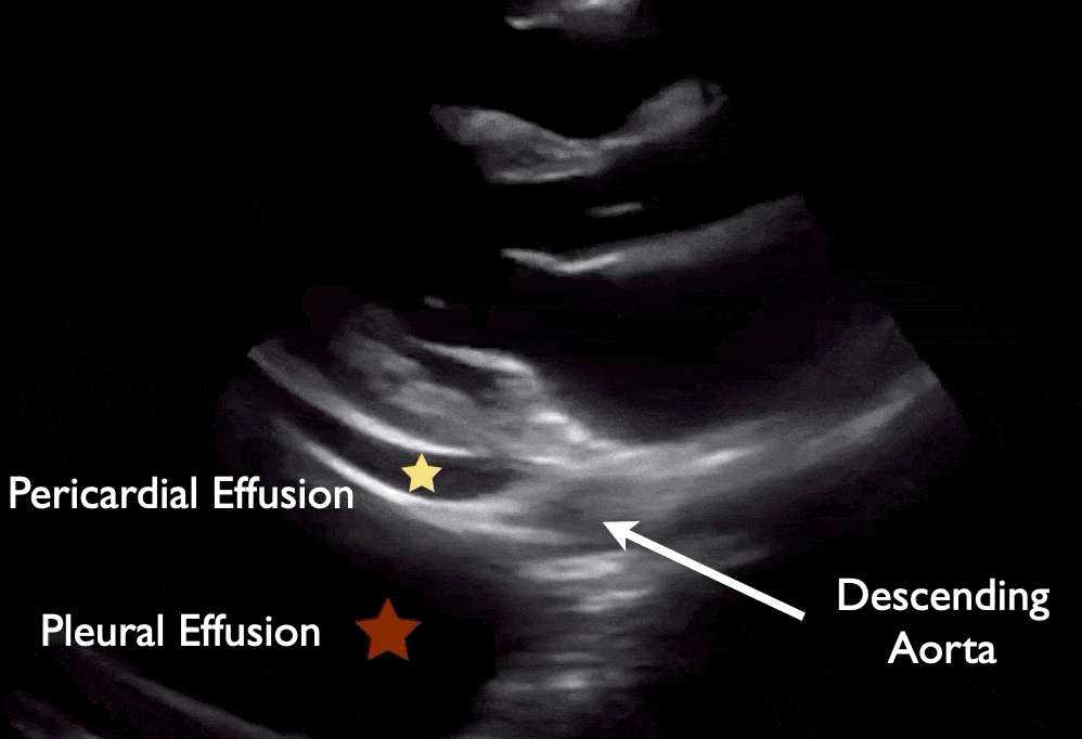 Pericardial Effusion and Pleural Effusion Cardiac Ultrasound Echocardiography