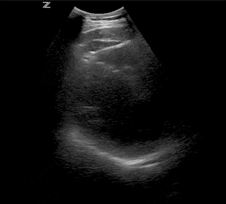 Pericardial Fat Pad Cardiac Ultrasound Echocardiography POCUS