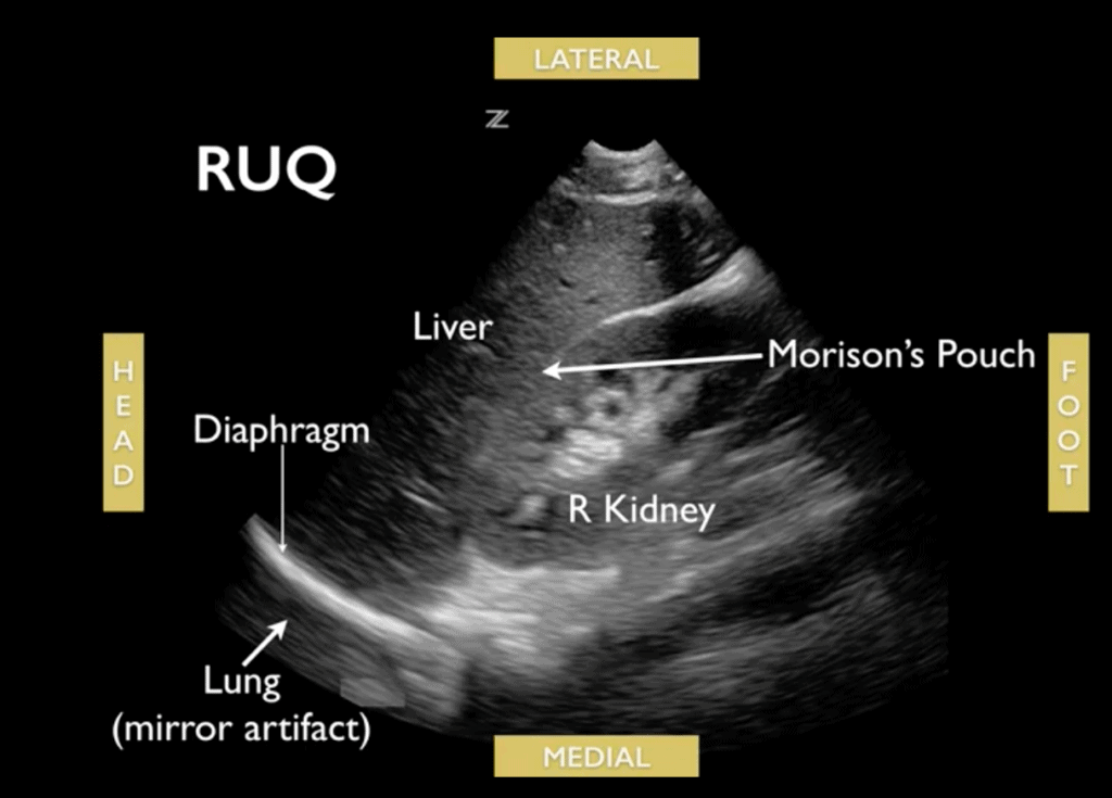 Right Upper Quadrant RUQ eFAST FAST scan Ultrasound - Labeled Morison's Pouch