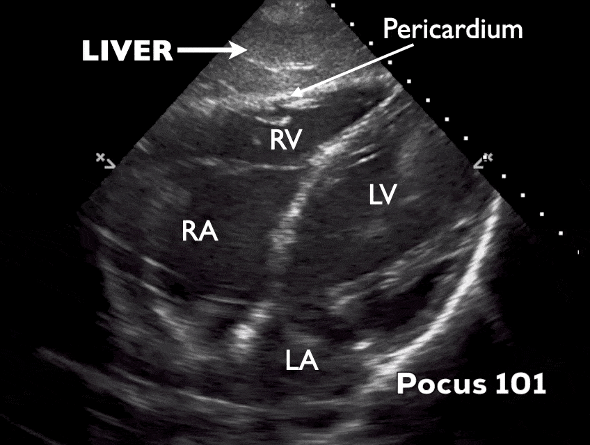 Subxiphoid View Ultrasound Echocardiography Video POCUS