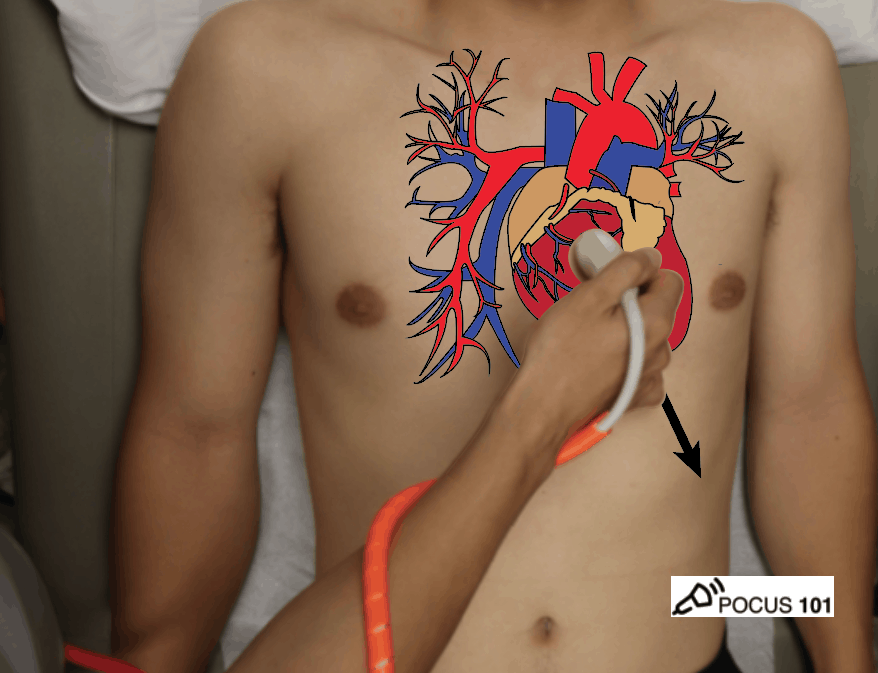 eFAST FAST Parasternal Long Axis Cardiac Ultraosund Anatomy Probe Position Illustration Echocardiography