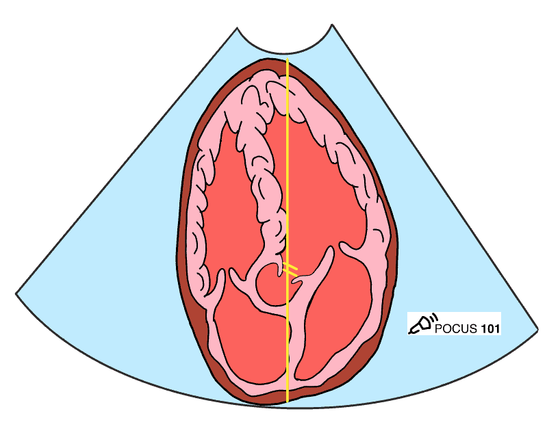 Apical 5 Chamber View for Cardiac Output Echocardiography Ultrasound Pulse Wave Gate