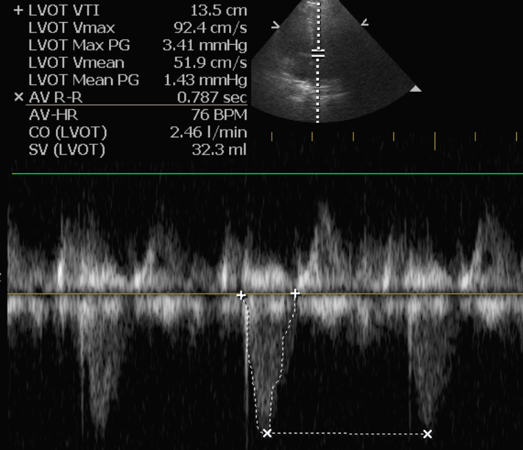 Cardiac Output on Ultrasound Screen