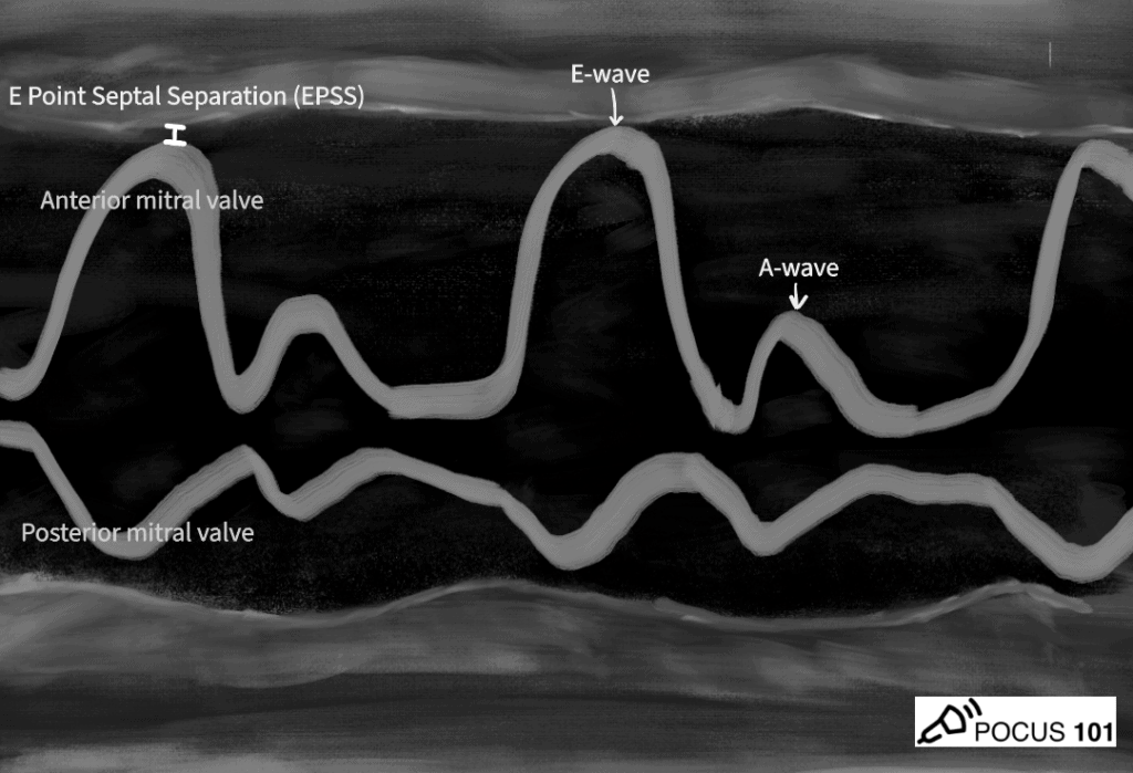 E-point septal Separation EPSS Cardiac Ultrasound Echocardiography POCUS
