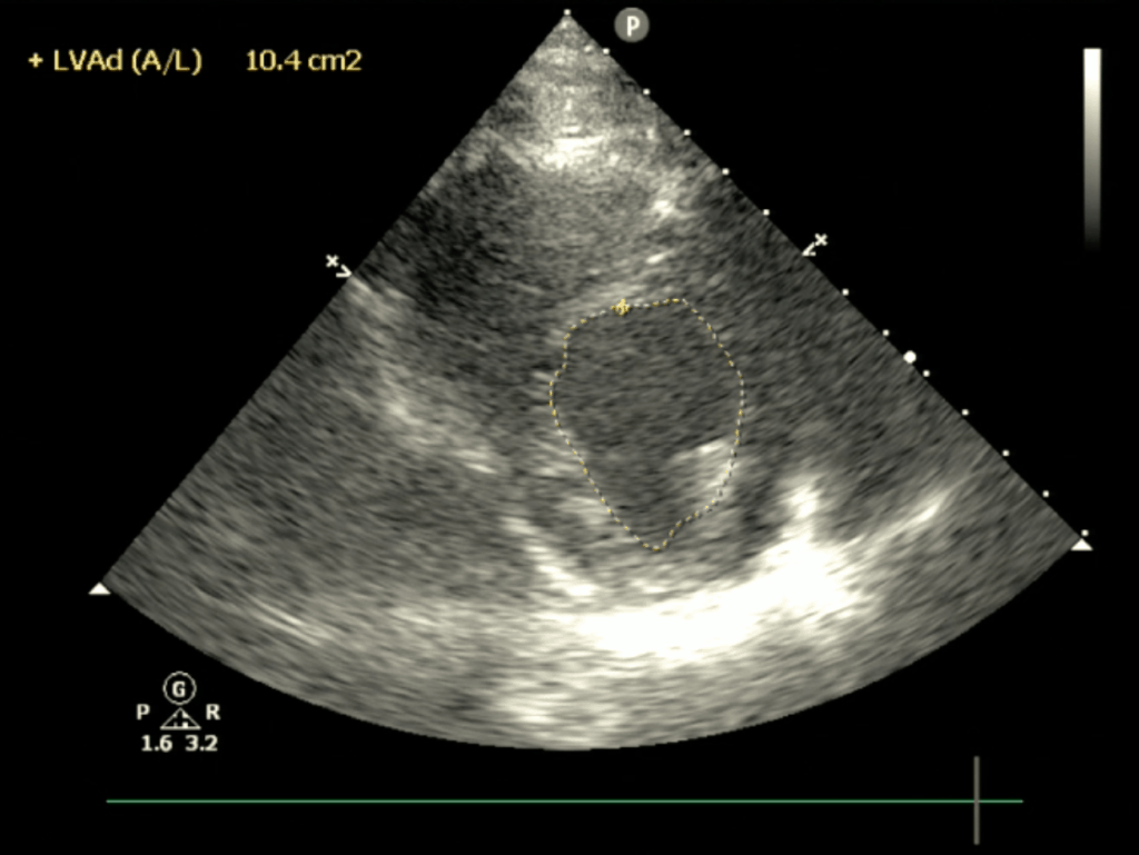Fractional Area of Change FAC POCUS Cardiac Ultrasound Echocardiography Diastole