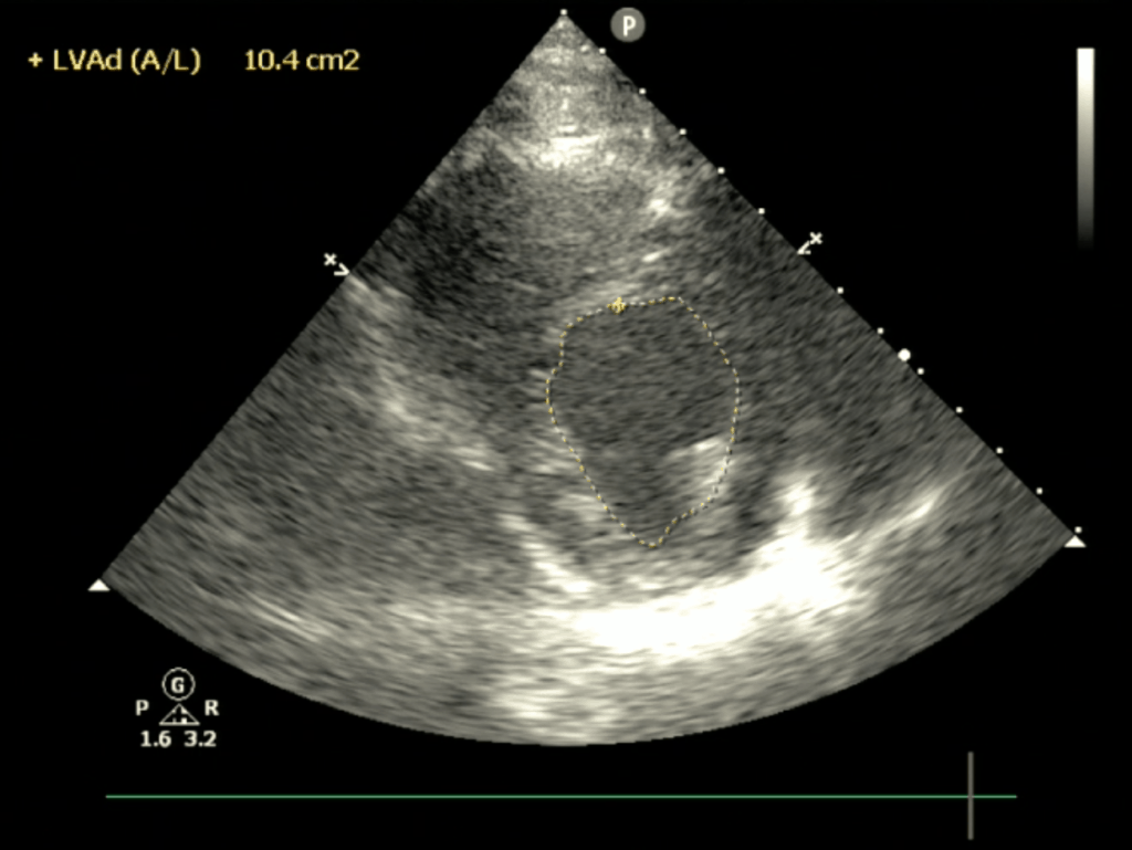 Case 43: Significant Spontaneous Echo Contrast In Left Ventricle (  DCM/Severe LV Dysfunction / LVEF : 15% in M- Mode / LVEF : 10% In Simpson's  Method., By Interesting cases in Echocardiography