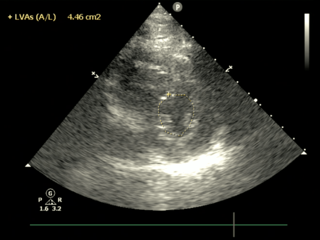 Fractional Area of Change FAC POCUS Cardiac Ultrasound Echocardiography Systole
