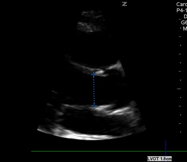 LVOT Diameter Measured Zoomed in Cardiac Ultrasound Echocardiography