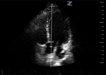 LVOT VTI PW Doppler Placement with Apical 5 Chamber View