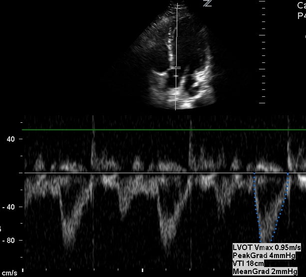 LVOT VTI tracing Measured Ultrasound Echocardiography Cardiac