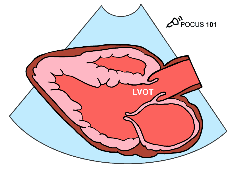 Parasternal Long Axis with Aortic Valve and LVOT
