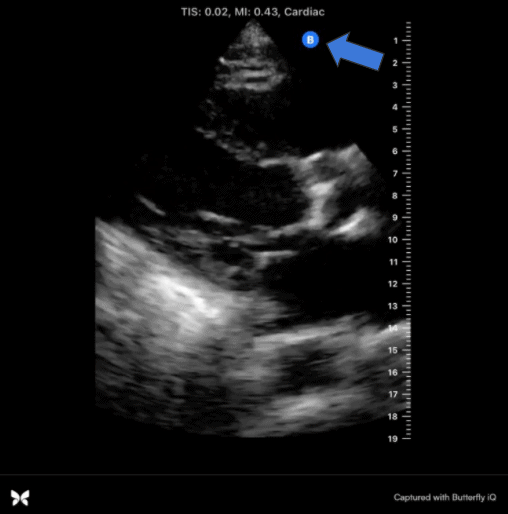 Cardiac Ultrasound Image Orientation Marker