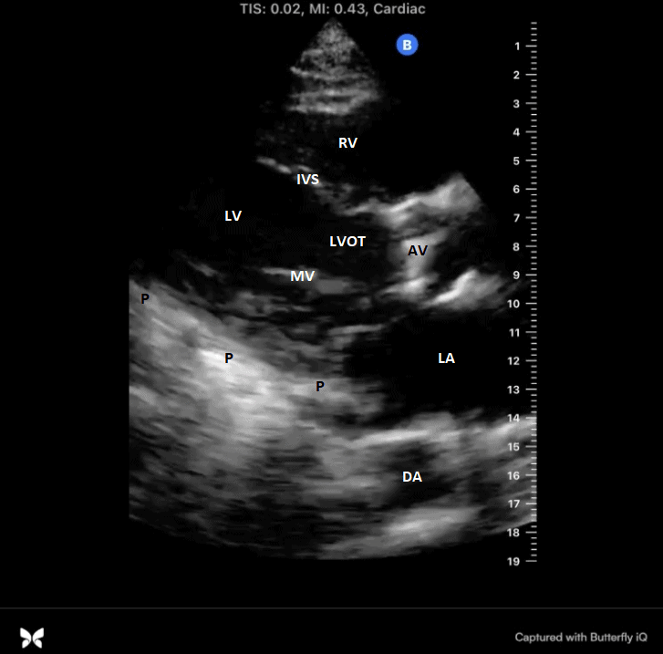 Parasternal Long Axis View Labeled