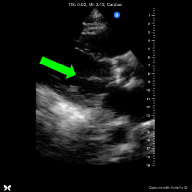 Parasternal Long Axis view anterior mitral valve leaflet systolic heart failure cardiac ultrasound echo