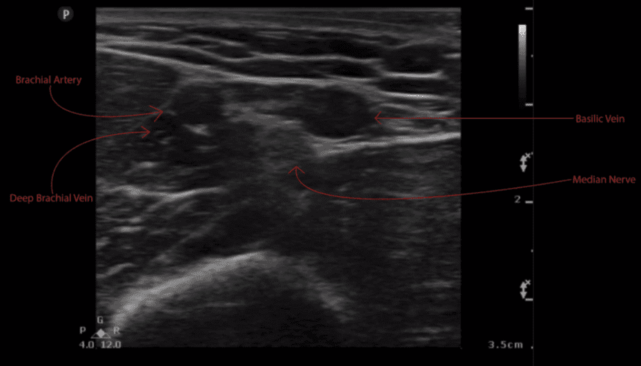 Ultrasound Guided Peripheral IV PIV Annotated