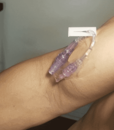 Ultrasound Guided Peripheral IV PIV taping down catheter