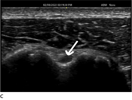 Anterior shoulder ultrasound Long head biceps tendon LHBT in short axis anisotropy
