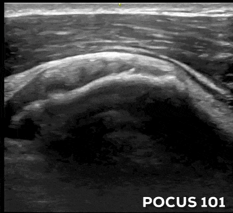 Anterior shoulder ultrasound Subscapularis Fanning Short Axis