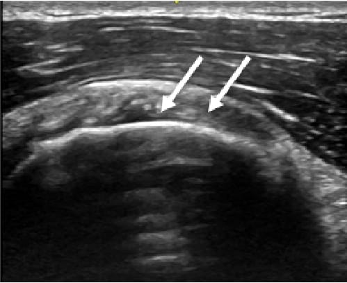 Anterior shoulder ultrasound Subscapularis Short Axis View Ultrasound Image with Anisotropy