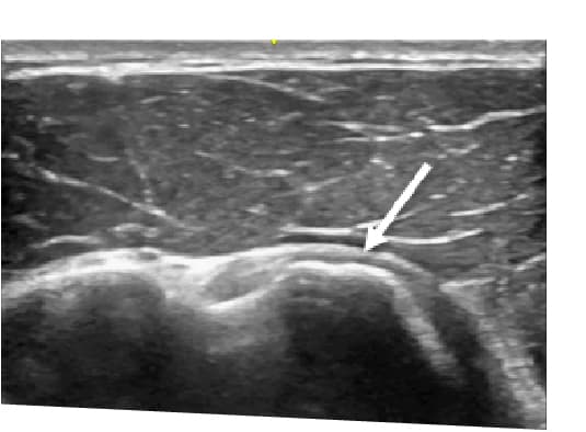 Anterior shoulder ultrasound Subscapularis Short Axis with LHBT