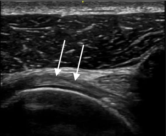 Anterior shoulder ultrasound Subscapularis in Longitudinal axis with anisotropy