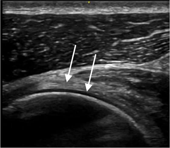 Anterior shoulder ultrasound Subscapularis in Longitudinal axis