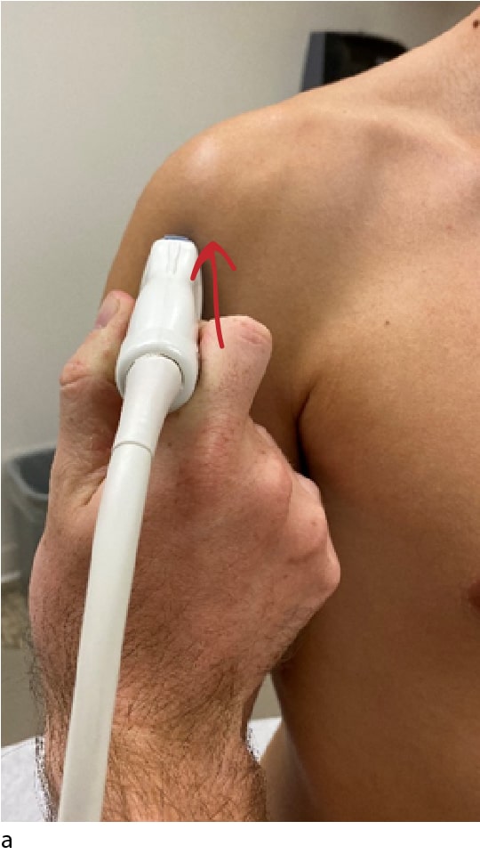 Anterior shoulder ultrasound long head biceps tendon LHBT in long axis probe placement
