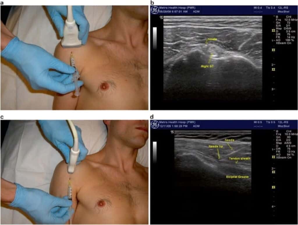 Anterior shoulder ultrasound long head biceps tendon LHBT short and long axis injection
