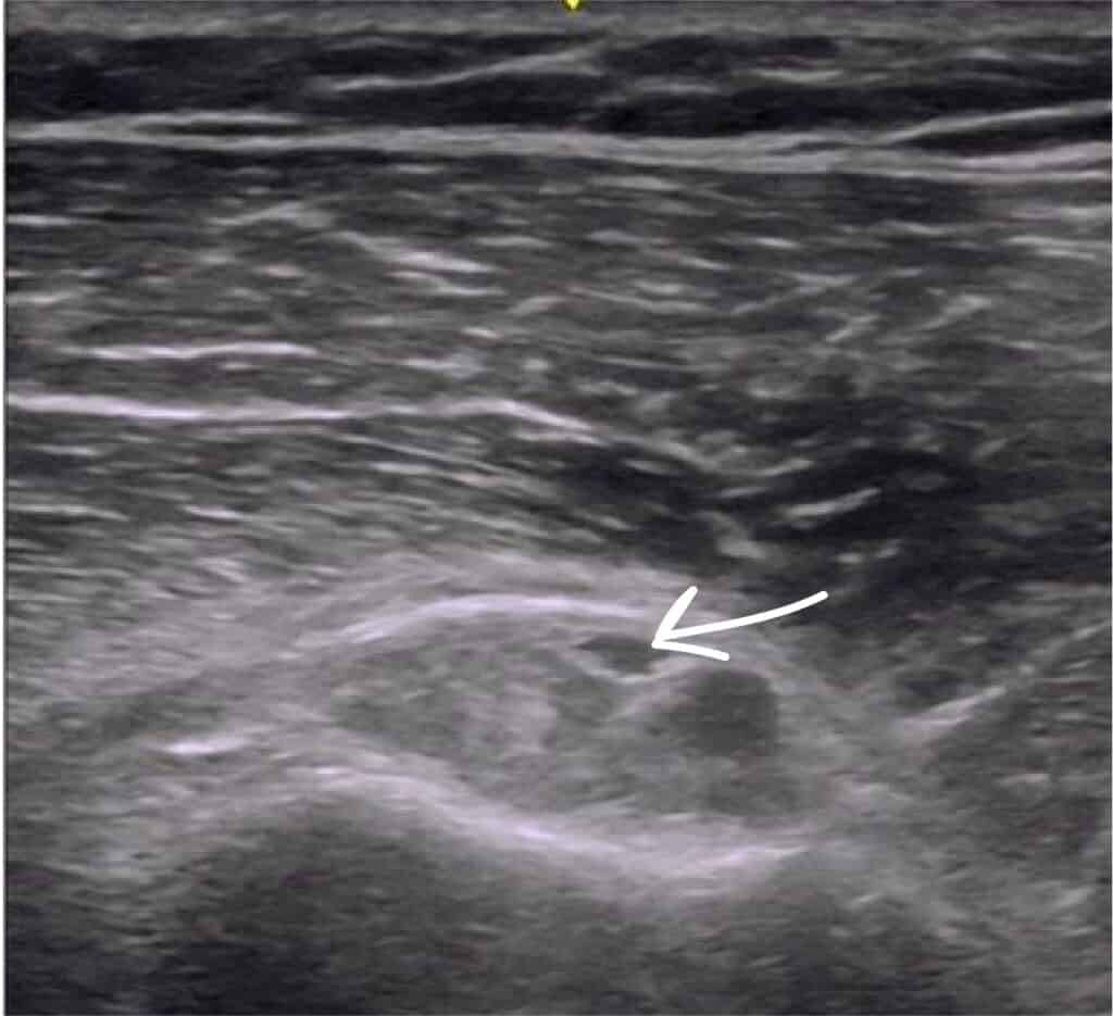 Anterior shoulder ultrasound pathology long head biceps tendinosis