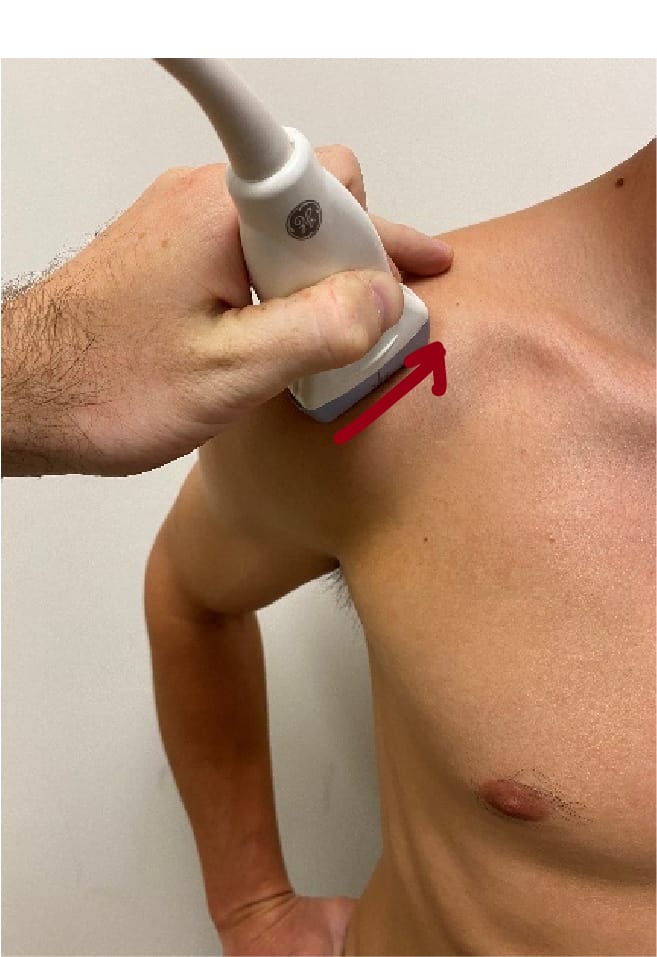 Anterolateral shoulder ultrasound Long axis probe placement