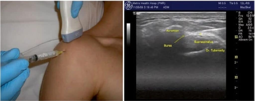 Anterolateral shoulder ultrasound long axis oblique injection