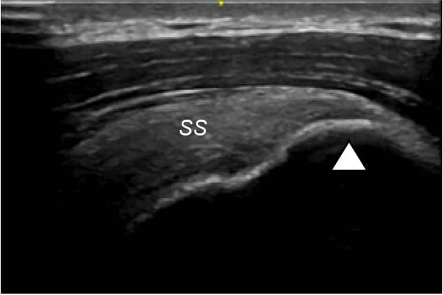 Anterolateral shoulder ultrasound long axis ultrasound image