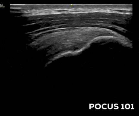 Anterolateral shoulder ultrasound supraspinatus SST Fanning between Superior and middle facets
