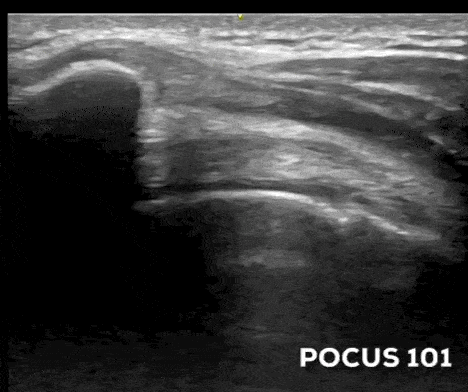 Anterolateral shoulder ultrasound supraspinatus SST Impingement Test