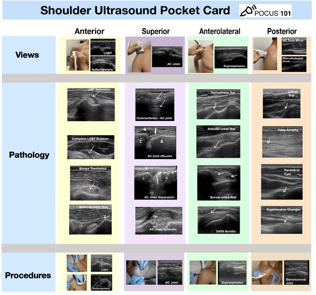 Shoulder Ultrasound Pocket Card POCUS 101