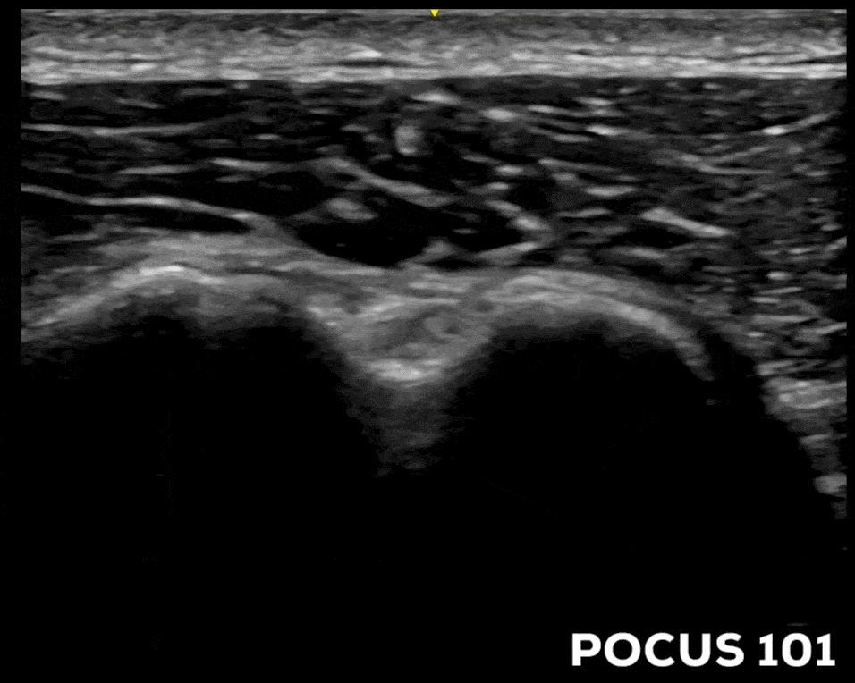 Shoulder ultrasound Anterior Long Head Biceps Tendon LHBT Anisotropy