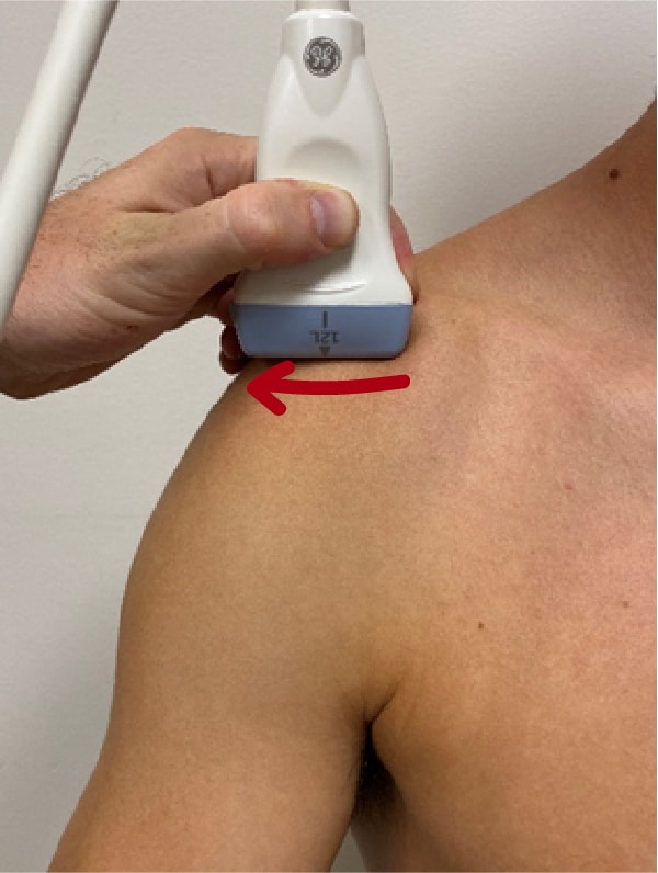 Superior shoulder ultrasound AC joint probe placement
