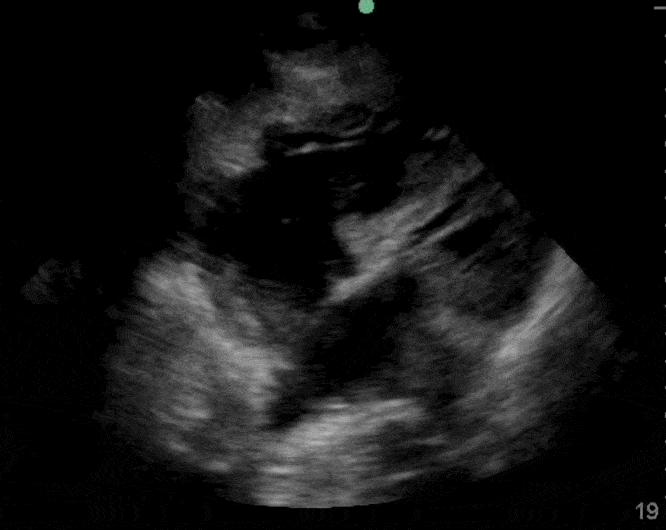 Ultrasound Guided Central Line CVL Bubble Study Confirmation