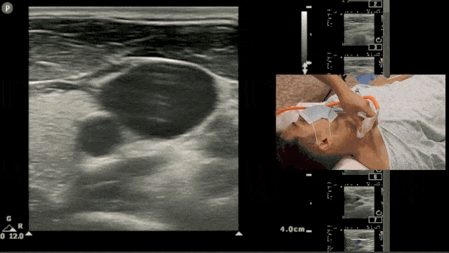 Ultrasound Guided Central Line CVL Effects of Head Turning