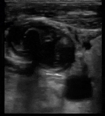 Ultrasound Guided Central Line CVL IJ Thrombus
